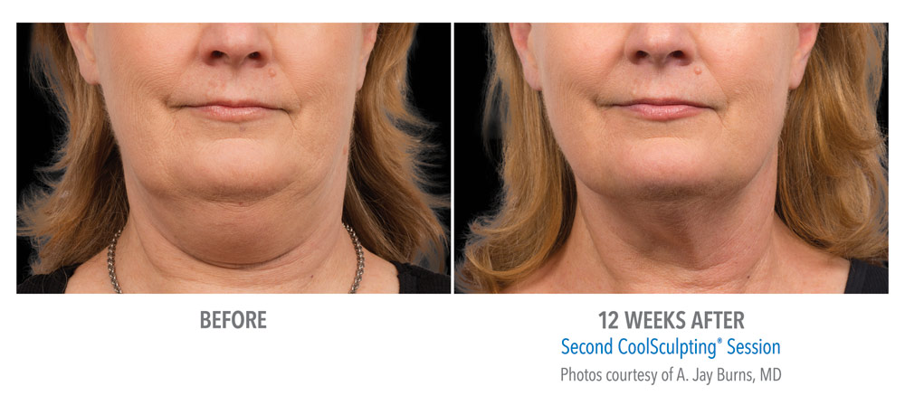 Neck Fat Reduction with CoolSculpting &#8211; Special Offer $200 Off 1st Treatment