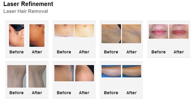Laser Hair Removal Before and After Photos