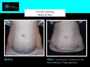 Four Weeks Post CoolSculpting, My Experience So Far &#8211; Patient Review Los Angeles, CA