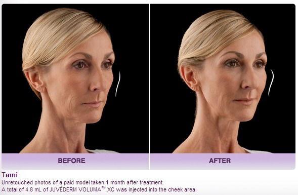 juvederm voluma before and after photo