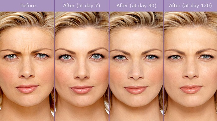 What is the cost of Botox?