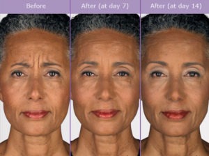 Botulinum Toxin (Botox) Risks and Safety | Beverly Hills Medical Spa