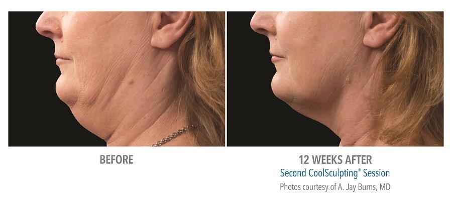 Get Rid of Your Double Chin