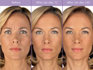 Your Botulinum Toxin (Botox) Consultation | Beverly Hills Medical Spa