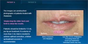 Restylane Lip Enhancement Treatment Cost | Beverly Hills | Los Angeles