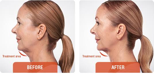 Kybella Non Surgical Chin Fat Reduction Beverly Hills Los Angeles