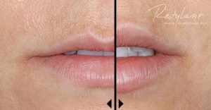 What are Hyaluronc Acid Dermal Fillers Like Juvederm and Restylane?