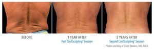 Long-term Effects of Coolsculpting