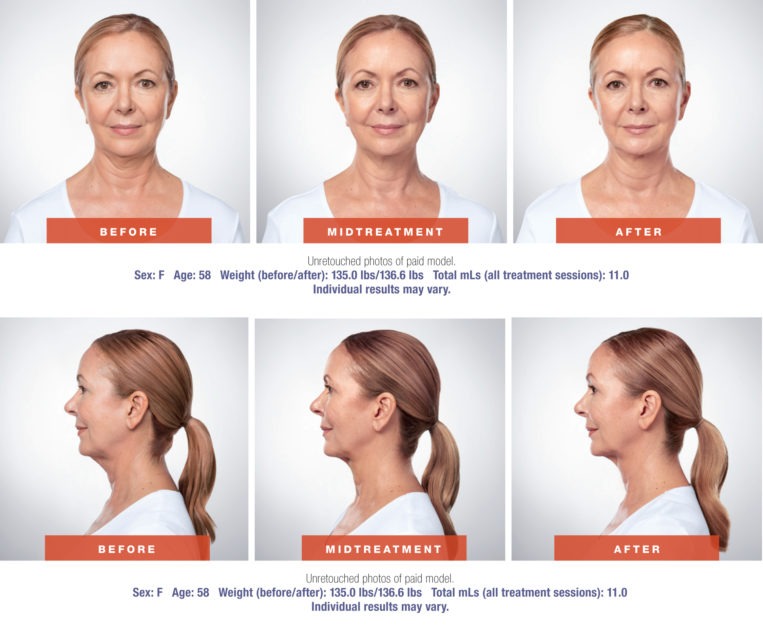 Kybella Injections Vs Chin Liposuction To Reduce Chin Fat Beverly