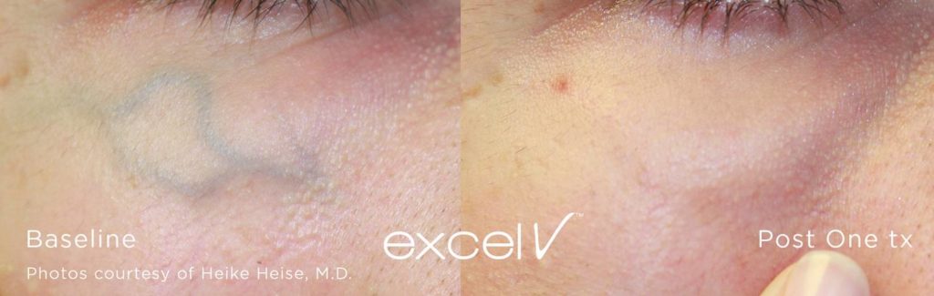 Excel V Vascular Laser Vascular And Pigmentation Laser Treatment Before &#038; After Photos 