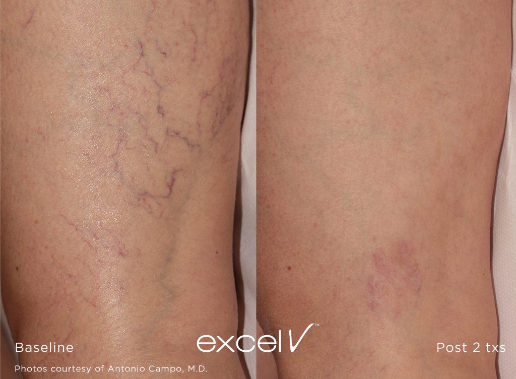 Excel V Laser Vascular Lesion Treatment